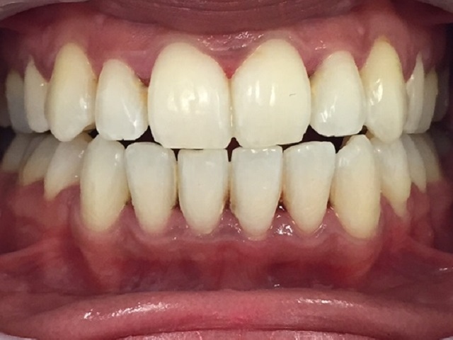 Case1AnteriorTeethAfter Case1AnteriorTeethAfter