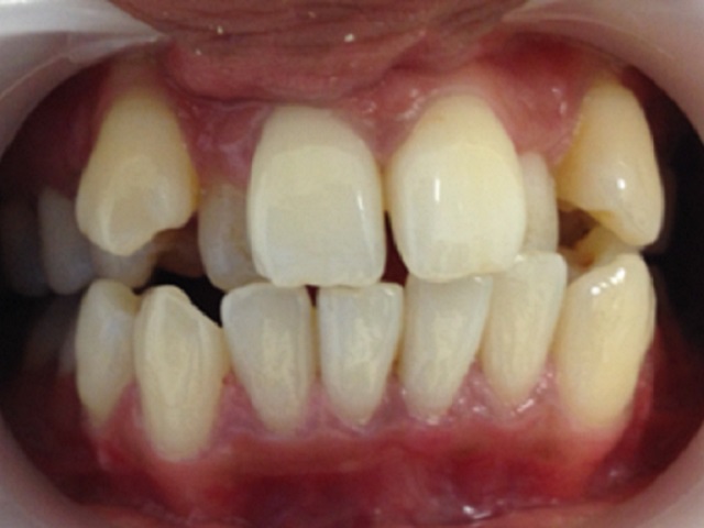 Case1AnteriorTeethBefore Case1AnteriorTeethBefore