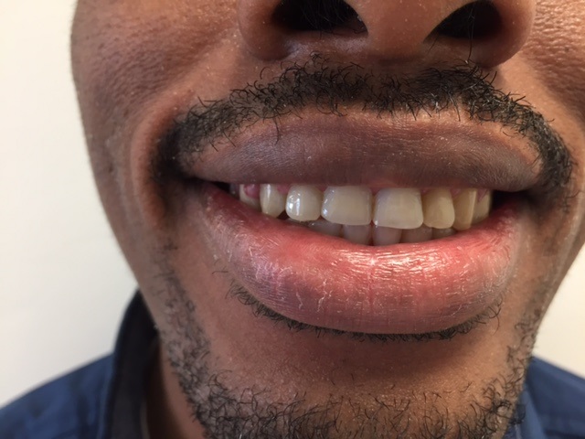 Case2AnteriorAfter (1) Case2AnteriorAfter (1)