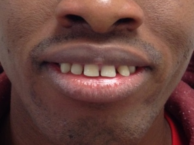 Case2AnteriorBefore (1) Case2AnteriorBefore (1)