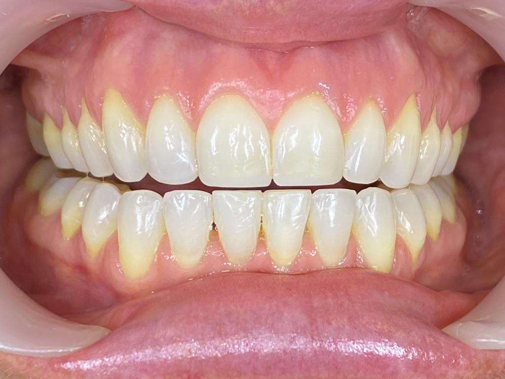 after-teeth (1) after-teeth (1)