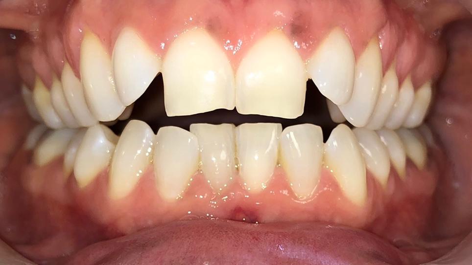 before-teeth before-teeth