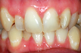 cd25 cd25