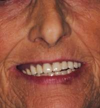 implant1-after implant1-after