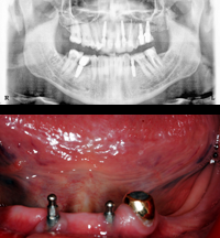 implant1-before implant1-before