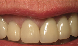 implants-after implants-after