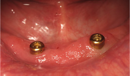 implants-before implants-before