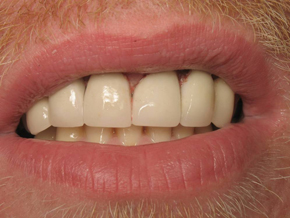 smile1-after smile1-after