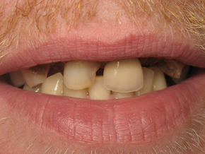 smile1-before smile1-before